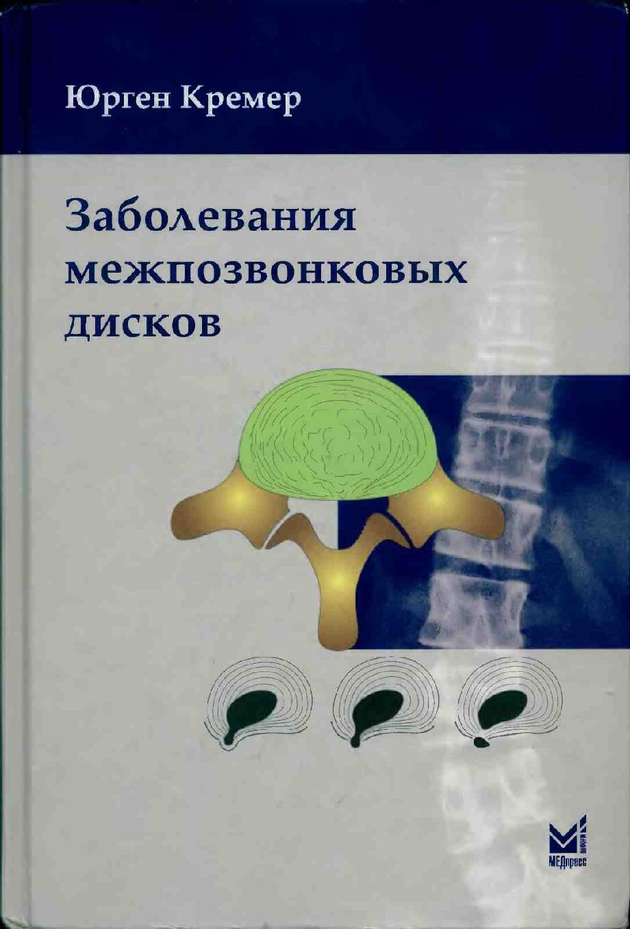 Заболевания межпозвонковых дисков
